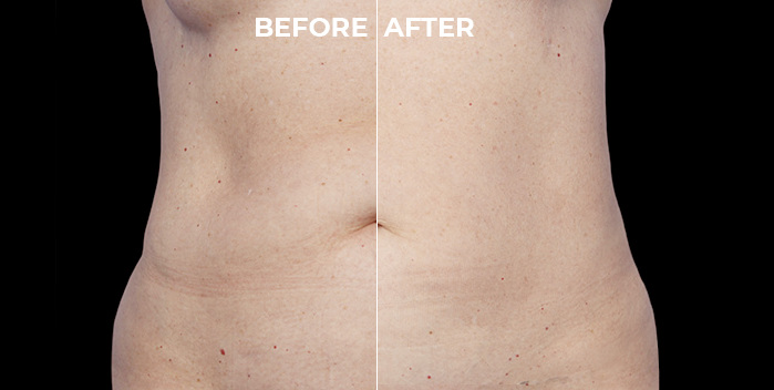 CoolSculpting Elite Before and After on the Abdomen Area